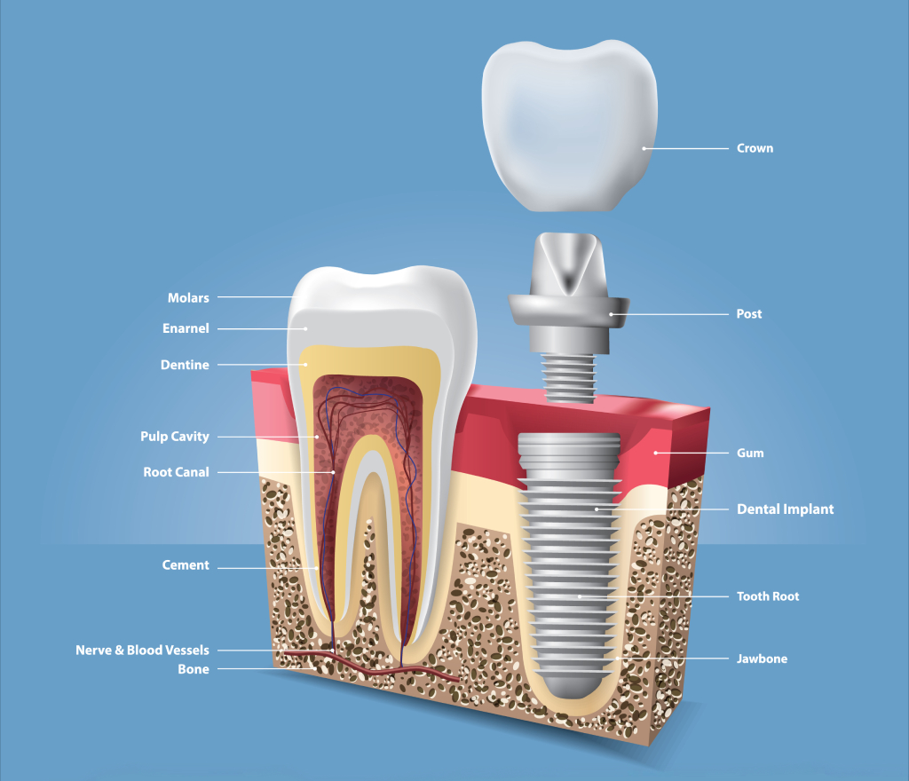 dental-implants-in-gurgaon