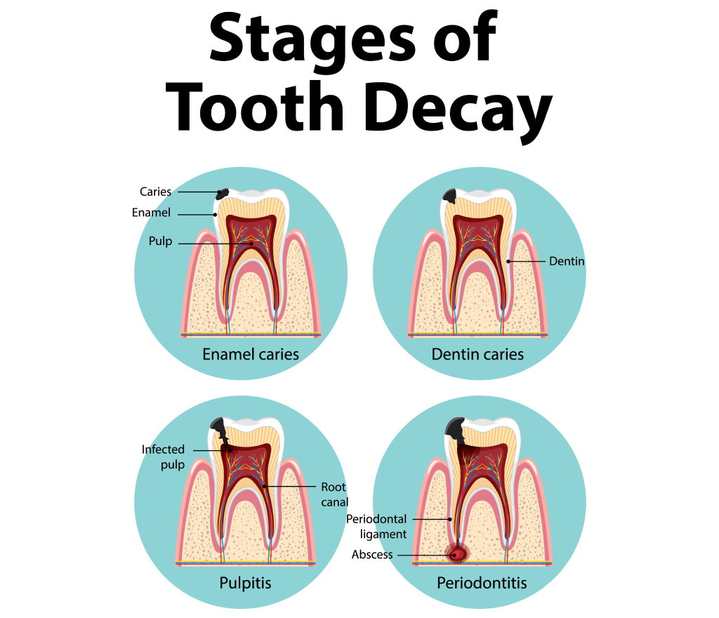 painless-root-canal-treatment-gurgaon