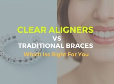clear aligners vs traditional braces