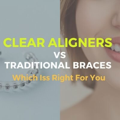clear aligners vs traditional braces