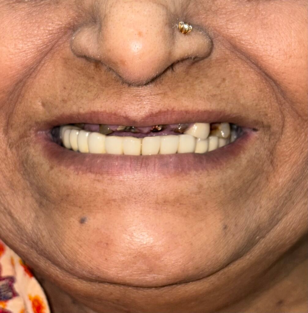 Pre op Smile close up for diagnostic assessment of smile line. The gums are slightly visible which needs to be a considering factor 