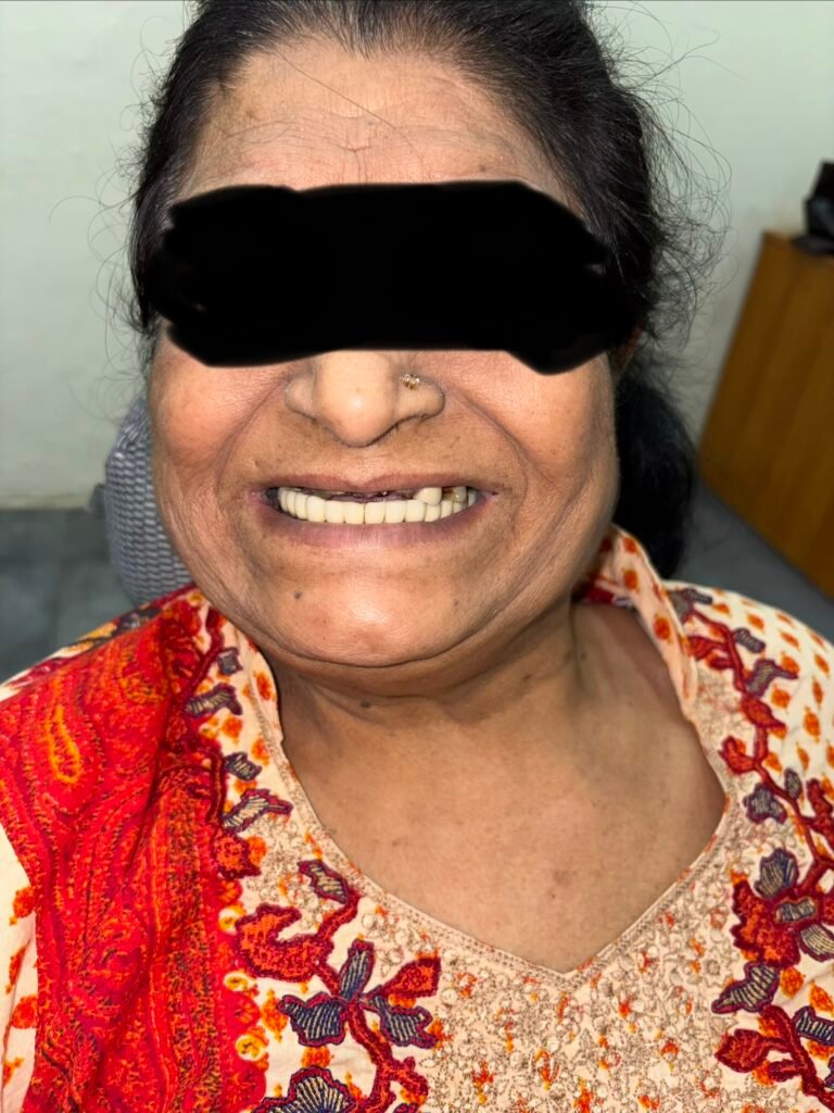 Before smile picture full mouth dental implants gurgaon case report 