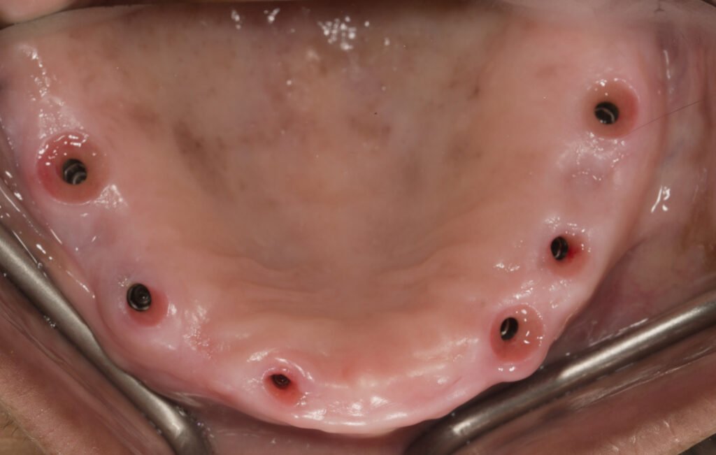 This image shows good keratinised soft tissues vertically and all around the implants which is an important parameter for implant success