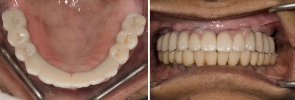 Final prosthetic on this full mouth implant case