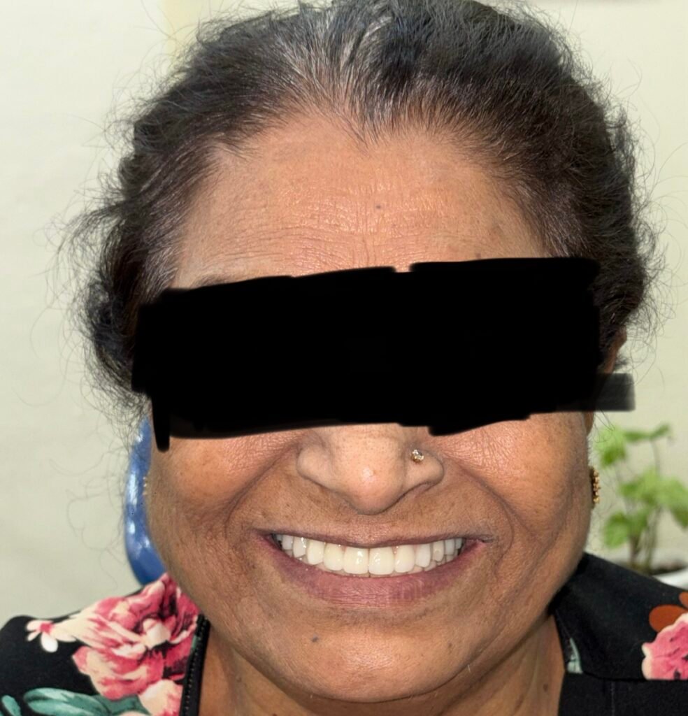 After full mouth dental implants and prosthetic phase, final smile