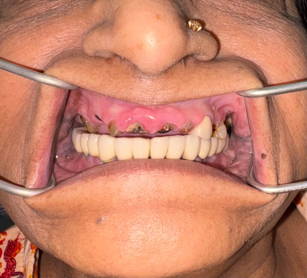 Very limited inter arch space to be considered before planning a full mouth implant procedure