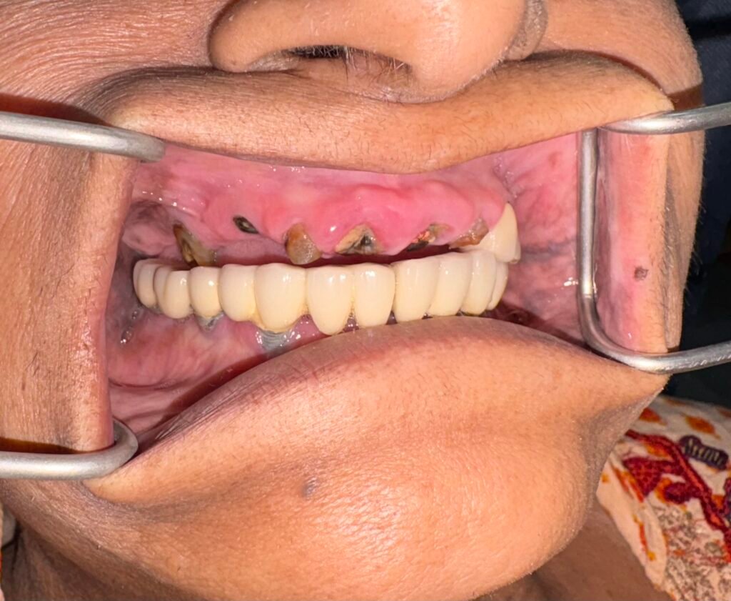 Bite picture on the right to determine the vertical space