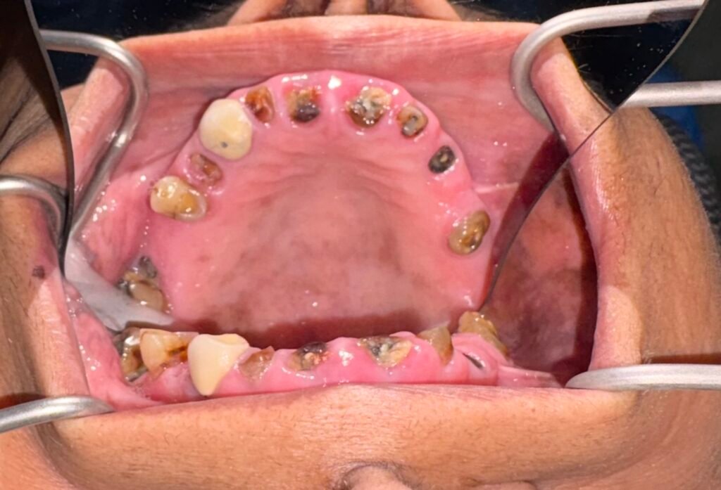 Pre op occlusal