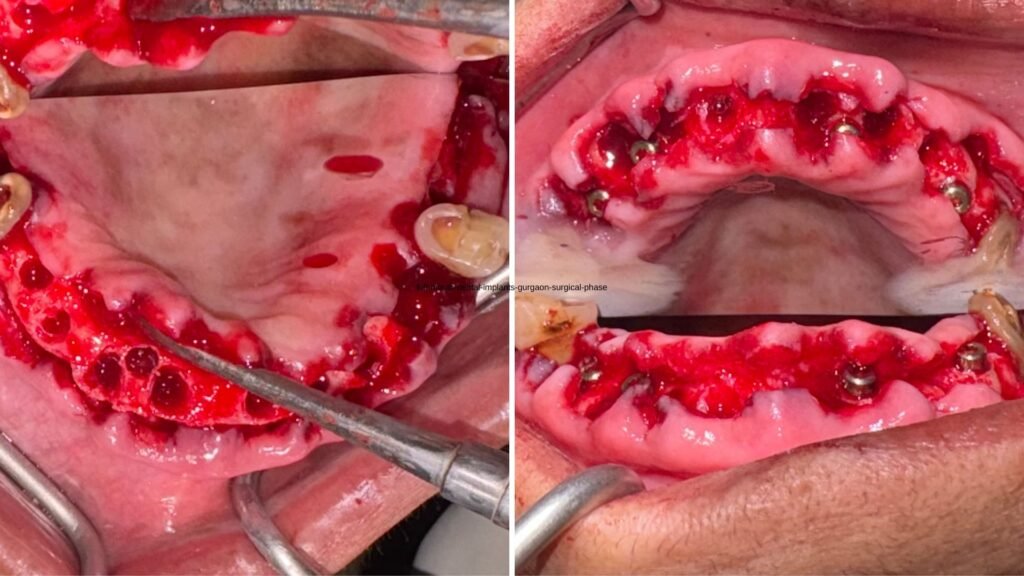 Surgical phase and implant placement for full mouth implants