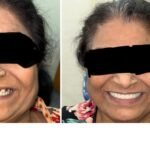 full-mouth-implants-gurgaon-before-and-after