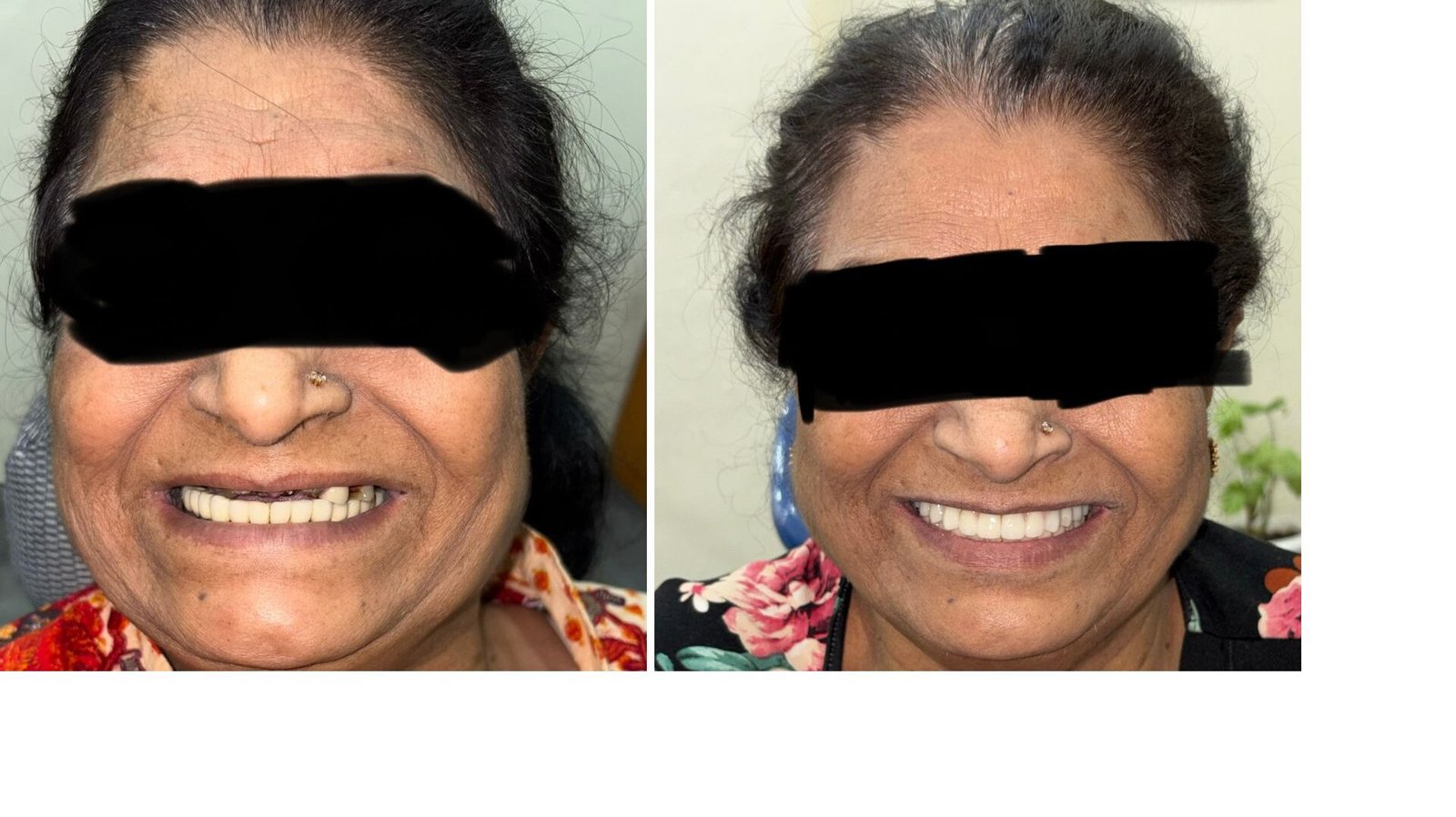 full-mouth-implants-gurgaon-before-and-after