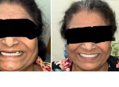 full-mouth-implants-gurgaon-before-and-after