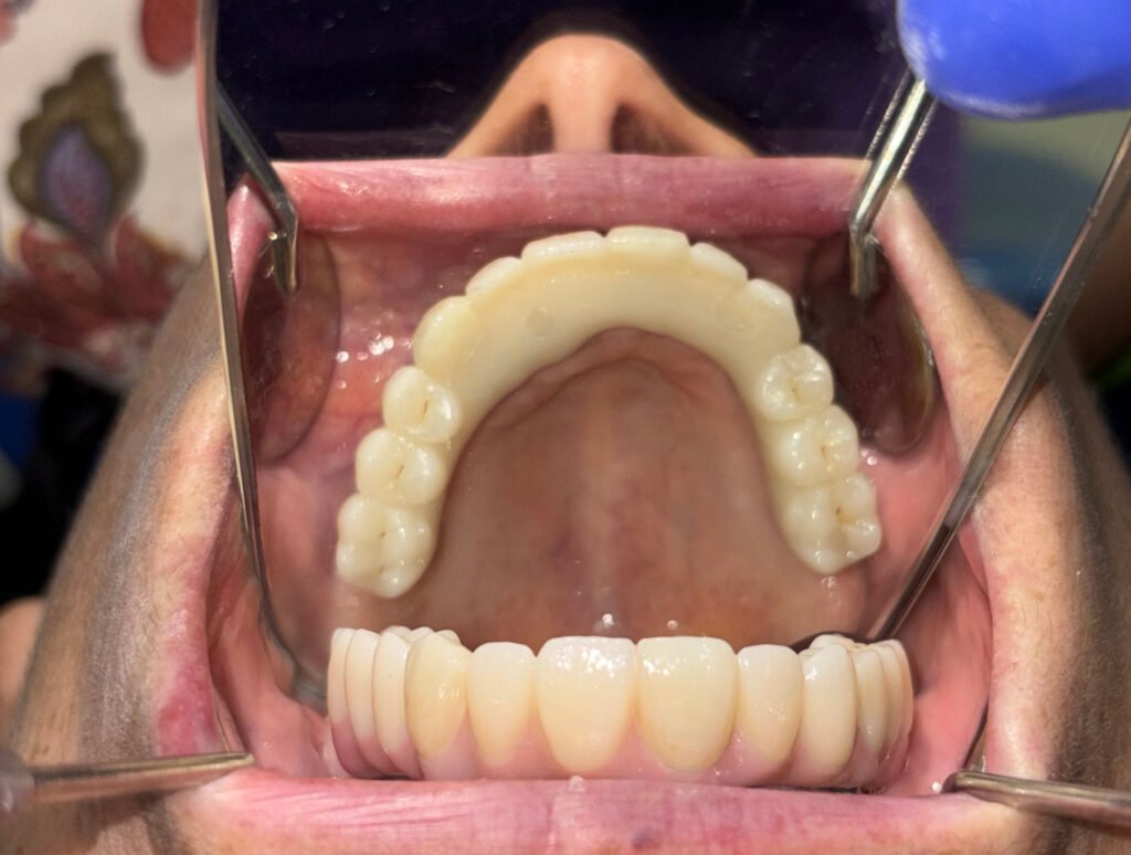 occlusal view of the final prosthesis.