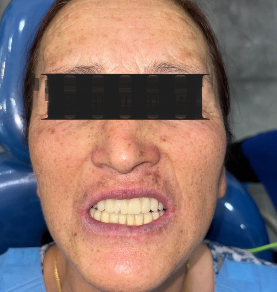 Temp prosthesis after 3 months of healing. The temp prosthesis is evaluated for esthetics and speech