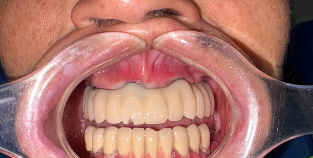 Close up view of the temp prosthesis
