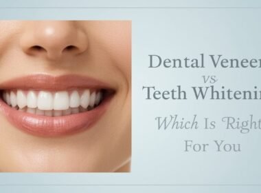 dental veens vs teeth whitening