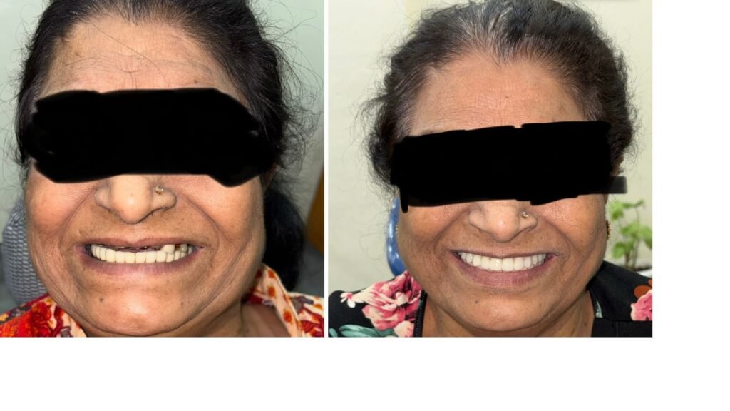 dental clinic Sector 66 Gurgaon - full mouth implants before after - Restore Dental